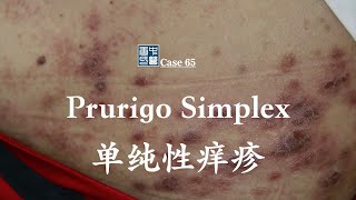 Prurigo Simplex treated by natural and safe way [upl. by Patnode486]