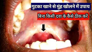 OSMF treatment in Hindi in Hindi submucous fibrosis मुंह के कम खुलने का उपाय [upl. by Leiser742]