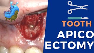 Apicoectomy surgery  Live procedure step by step [upl. by Ahcsim]