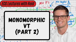 Monomorphic VT Part 2  Day 22 ECG Challenge [upl. by Behre988]