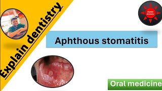 Aphthous stomatitis Lecture  Introduction  classification clinical features etiology Management [upl. by Knitter]