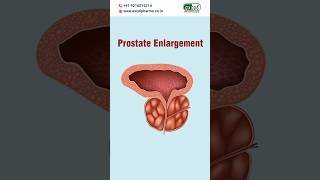 Homeopathic Medicine for Prostate Enlargement shorts prostateenlargement homeopathyasitis [upl. by Kannan]