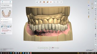 Immediate Lower Denture Digital Design [upl. by Bradstreet]