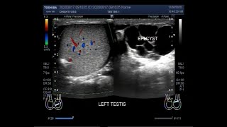 Ultrasound Video showing an Epididymal cyst [upl. by Waterer]