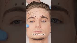 How do you mark up the crows feet for male Botox patients malebotox botox brotox antiwrinkle [upl. by Negris685]