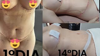 14 DIA DA ABDOMINOPLASTIA [upl. by Oinotnanauj]