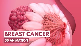 5 Signs of Breast cancer  3D Animation [upl. by Skolnik]