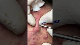 The Battle Against FullFace Infected Acne A Meticulous Extraction Process [upl. by Gerlac976]