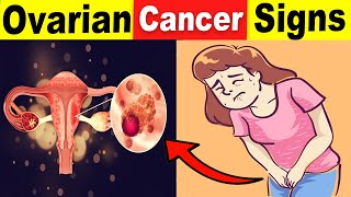 9 Common Ovarian Cancer Signs That You Should Never Ignore [upl. by Nnewg]