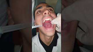 Local Anaesthesia Demonstration of Inferior Alveolar Nerve Block [upl. by Nailil216]