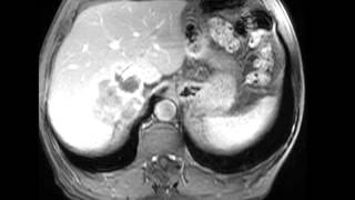 Retroperitoneal Liposarcoma [upl. by Shotton]