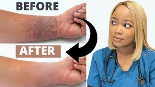 How to Treat ECZEMA  Black Brown skin  Dry Skincare Routine The 1 Best Remedy for Eczema [upl. by Paulie562]