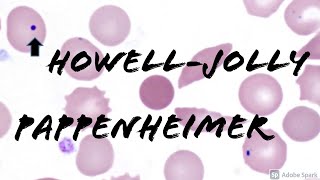 Pappenheimer Bodies amp HowellJolly Bodies Peripheral Blood Smear Hematology amp Hematopathology [upl. by Atiniuq]