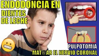 ENDODONCIA EN NIÑOS  PULPOTOMIA PASO A PASO parte 1 COMO ALIVIAR EL DOLOR DE DIENTES DE LECHE [upl. by Ellary584]