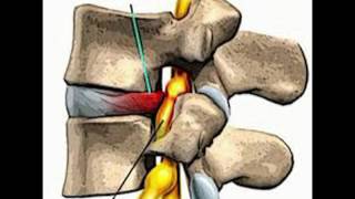 LUMBALGIA  LUMBOCIATALGIA CAUSAS DE LAS LESIONES [upl. by Estelle]