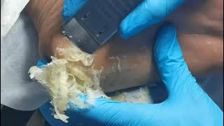 Massive dead skin on heel and Remove it slowly amp carefully Cracked heel treatment amp Callus removal [upl. by Englis]