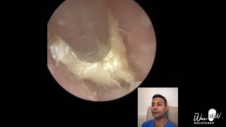 1527  Dead Skin Plug Extracted from Ear [upl. by Saihttam]