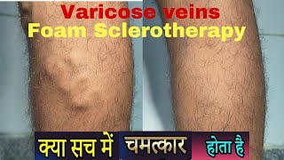 Miracle of foam Sclerotherapy for varicose veins Varicose veins treatment in Ranchi for SSC GD [upl. by Novar]