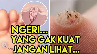 Cara Mengatasi Mata Ikan Dengan Cepat Dan Aman [upl. by Ehtiaf]