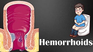 Hemorrhoids  Types Causes Risk Factors Signs amp Symptoms Diagnosis amp Treatment [upl. by Nafri82]