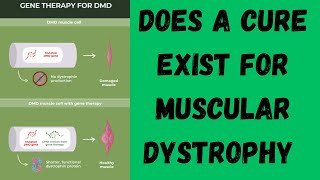 Does a cure exist for muscular dystrophy [upl. by Saile]