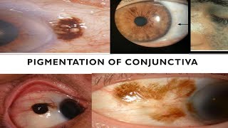 PIGMENTATIONS OF CONJUNCTIVA  Are they cancerous [upl. by Siffre]