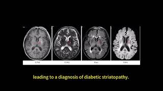 Chorea in hemodialysis patients – Video abstract 490816 [upl. by Sheffie]