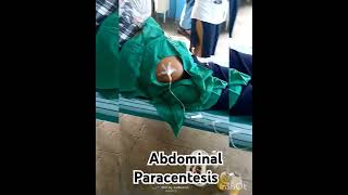 abdominal tapping for ascitic fluid medicose aryangla paracentesisSudarshanlipane17🏥⛑️💖🩺😷 [upl. by Komara]