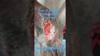 Foot Ulcer Homeopathic Treatment [upl. by Jade968]