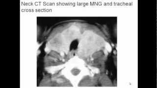 Multinodular Goiter Evaluation and Management [upl. by Sadoff587]