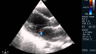 MAYOCARDITES IN LEPTOSPIROSIS  ECHOCARDIOGRAPHY [upl. by Hgielek78]