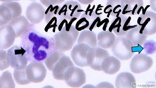 MayHegglin Anomaly Döhle bodylike inclusions amp giant platelets Hematology amp Hematopathology [upl. by Rhea785]