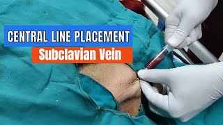 Central Line placement Subclavian Vein Approach [upl. by Kermie]