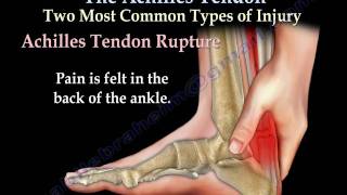 Achilles Tendon rupture tear tendonitis  Everything You Need To Know  Dr Nabil Ebraheim [upl. by Maryanna]