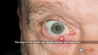 Are styes contagious and what can I do about them  Ask an Ophthalmologist [upl. by Aidan]