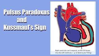 Pulsus Paradoxus amp Kussmauls Sign A Sign of Heart Trouble A Live Lecture [upl. by Aelyk]