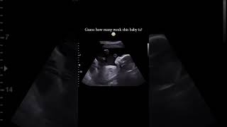 Baby movement in womb pregnancycare pregancy ultrasound [upl. by Summers]