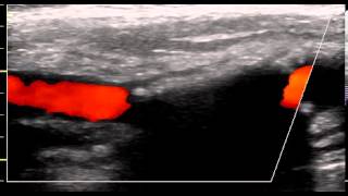 INTERNAL CAROTID ARTERY CALCIFIC PLAQUE [upl. by Remas]