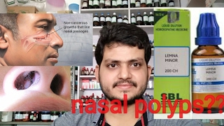 Nasal polypsHomeopathic medicine for nasal polyps explain [upl. by Emya]