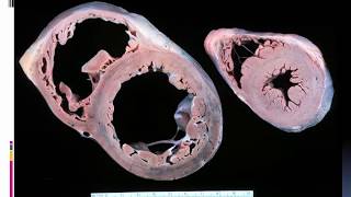 Cardiomyopathies in echocardiograpghy Dr Ahmed Onsy [upl. by Atalie]