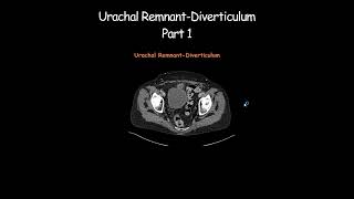 Urachal RemnantDiverticulum Part 1 radiology radiologist embryology urinarybladder [upl. by Selbbep]