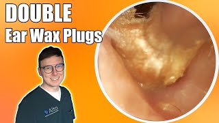 “Unbelievable difference”  Hearing TRANSFORMED after removing two plugs  Ear Wax Removal Ep 10 [upl. by Ebag761]