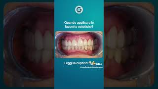 Prima e dopo  Faccette dentali [upl. by Thais]