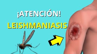 LEISHMANIASIS✅🦟 Ciclo de vida fisiopatologia síntomas diagnóstico y tratamiento MUY FÁCIL😱 [upl. by Eagle]