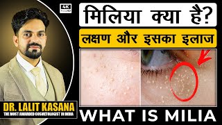 WHAT IS MILIA  मिलिया क्या है लक्षण और इसका इलाज DR LALIT KASANA [upl. by Filomena]