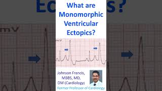 What are monomorphic ventricular ectopics [upl. by Chud]