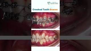 Crooked Teeth Braces shorts dentist braces [upl. by Halueb]