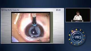 Increase Intraocular Pressure with Trabecular Meshwork Photocoagulation [upl. by Amoihc]