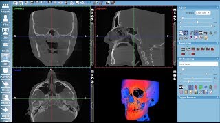 Creating a pseudo panoramic view of 3D volume in Planmeca Romexis® [upl. by Genie]