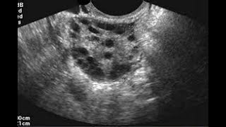 ADENOMIOSIS POR ECOGRAFÍA ADENOMIOSIS SIGNOS Y SÍNTOMAS TX ECOGRAFÍA DE ÚTERO ECOGRAFÍA PÉLVICA [upl. by Delphinia]